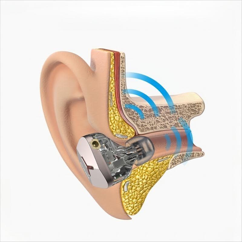 syeindunce syeindunce BGVP DMA 1DD + 2BA + 2BCD Hybrid Driver in Ear Monitor Earphones, HiFi Wired IEM Earbuds, Resin + Aluminum Alloy Cavit Headphones, Powerful Bass IEMs (Dianthus Silver)